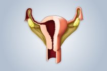 A endometriose poderia ser controlada com inje&ccedil;&otilde;es mensais de anticorpos