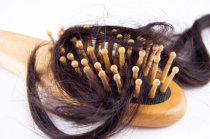 Alopecia areata foi associada a maiores riscos de comorbidades autoimunes e psiqui&aacute;tricas