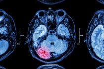 Anticoagulantes orais diretos t&ecirc;m se mostrado eficazes no tratamento da trombose venosa cerebral