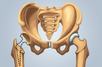 Artroplastia total do quadril e hemiartroplastia para fratura do quadril avaliadas por estudo publicado pelo <i>NEJM</i>