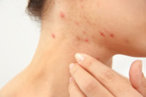 Associação entre acne em adultos e comportamentos alimentares Associação entre acne em adultos e comportamentos alimentares