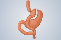 Cirurgia de bypass g&aacute;strico pode reduzir o risco de c&acirc;ncer de intestino