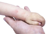 Dermatite at&oacute;pica foi associada ao aumento do risco de doen&ccedil;a inflamat&oacute;ria intestinal em adultos e crian&ccedil;as