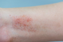 Dermatite at&oacute;pica infantil foi associada a maiores riscos de dificuldades de aprendizagem e mem&oacute;ria