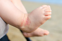 Eczema em crian&ccedil;as: lo&ccedil;&otilde;es, cremes e emolientes podem ajudar a prevenir a condi&ccedil;&atilde;o
