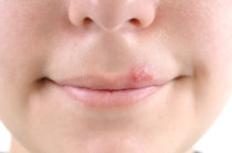 Estudo identifica como o sistema imunológico luta para manter o herpes sob controle Estudo identifica como o sistema imunológico luta para manter o herpes sob controle