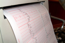 Fibrila&ccedil;&atilde;o atrial p&oacute;s-operat&oacute;ria pode sinalizar risco aumentado de hospitaliza&ccedil;&otilde;es por insufici&ecirc;ncia card&iacute;aca