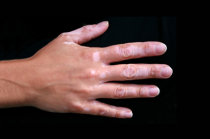 Inibidor t&oacute;pico da janus quinase foi aprovado para repigmenta&ccedil;&atilde;o de vitiligo: significativamente mais pacientes alcan&ccedil;aram 75% a 90% de melhora