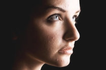 Inibidores da Janus Quinase foram associados a uma probabilidade quase 4 vezes maior de acne