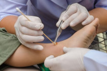 Nitrito de s&oacute;dio t&oacute;pico para &uacute;lceras cr&ocirc;nicas de perna em pacientes com anemia falciforme: ensaio cl&iacute;nico em fase 1 para determina&ccedil;&atilde;o de seguran&ccedil;a e tolerabilidade de dose