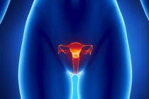 Rastreamento do c&acirc;ncer de ov&aacute;rio, utilizando o <i>Risk of Ovarian Cancer Algorithm (ROCA)</i>, identificou tumores incidentes em fase inicial e demonstrou alto valor preditivo positivo