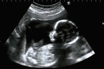 Reparo intrauterino de espinha b&iacute;fida grave com c&eacute;lulas-tronco mostra resultados promissores