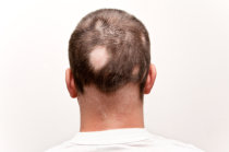 Um inibidor de JAK oral, Baricitinibe, produziu crescimento capilar dram&aacute;tico e dur&aacute;vel em pacientes com alopecia areata grave