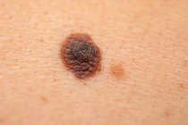 Vacina contra melanoma reduz pela metade o risco de recorr&ecirc;ncia e met&aacute;stase em 5 anos