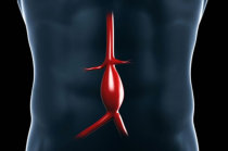 Vale a pena fazer triagem para aneurisma de aorta abdominal em homens? Dados de um estudo de coorte baseado em registros suecos