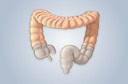 Bact&eacute;rias t&oacute;xicas podem ajudar a desencadear a colite ulcerativa, um tipo comum de doen&ccedil;a inflamat&oacute;ria intestinal