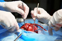 Cirurgia de revasculariza&ccedil;&atilde;o do mioc&aacute;rdio, o procedimento card&iacute;aco mais comum no Brasil, n&atilde;o &eacute; t&atilde;o segura para mulheres mais velhas