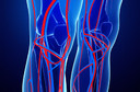 Cirurgia &eacute; melhor que terapia endovascular para a maioria dos pacientes com isquemia que amea&ccedil;a os membros