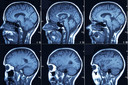 Combina&ccedil;&atilde;o de Tafinlar + Mekinist recebe aprova&ccedil;&atilde;o da FDA para glioma pedi&aacute;trico
