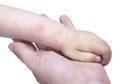 Dermatite at&oacute;pica foi associada ao aumento do risco de doen&ccedil;a inflamat&oacute;ria intestinal em adultos e crian&ccedil;as