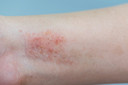 Dermatite at&oacute;pica infantil foi associada a maiores riscos de dificuldades de aprendizagem e mem&oacute;ria