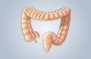 Diverticulite: revis&atilde;o sistem&aacute;tica publicada pelo JAMA