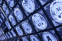 Esclerose m&uacute;ltipla: resultados do transplante aut&oacute;logo de c&eacute;lulas-tronco hematopoi&eacute;ticas publicado pelo JAMA Neurology