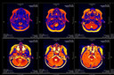 Estimula&ccedil;&atilde;o cerebral profunda pode reduzir o impacto emocional das mem&oacute;rias