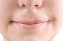 Estudo identifica como o sistema imunol&oacute;gico luta para manter o herpes sob controle