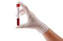 Exame de sangue diagnosticou com precis&atilde;o a doen&ccedil;a cel&iacute;aca em adultos