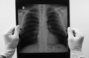 FDA aprova antibacteriano inovador para tratar doen&ccedil;a pulmonar grave