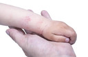 Maior gravidade da dermatite at&oacute;pica est&aacute; associada a dificuldades de aprendizagem em crian&ccedil;as