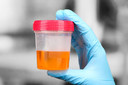 Medicamento antiss&eacute;ptico se mostrou t&atilde;o bom quanto antibi&oacute;ticos para prevenir infec&ccedil;&otilde;es do trato urin&aacute;rio recorrentes