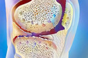 O fator de crescimento neural (NGF) pode desempenhar um papel mais importante na osteoartrite do que se pensava anteriormente