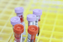 Previs&atilde;o da doen&ccedil;a de Alzheimer com 90% de precis&atilde;o usando fosfo-tau plasm&aacute;tica combinada com outras medidas acess&iacute;veis
