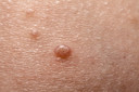 Primeiro tratamento aprovado para molusco contagioso - metade dos pacientes teve elimina&ccedil;&atilde;o completa das les&otilde;es
