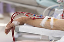 Suplementa&ccedil;&atilde;o de ferro associada &agrave; redu&ccedil;&atilde;o de 15% na mortalidade de doentes renais cr&ocirc;nicos recebendo agentes estimulantes da eritropoiese