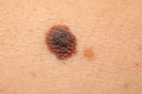 Vacina contra melanoma reduz pela metade o risco de recorr&ecirc;ncia e met&aacute;stase em 5 anos