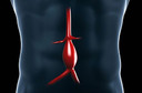 Vale a pena fazer triagem para aneurisma de aorta abdominal em homens? Dados de um estudo de coorte baseado em registros suecos