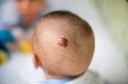 Pediatrics: retomada de crescimento de hemangioma infantil ap&oacute;s terapia com propranolol